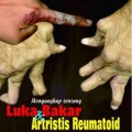 Mengungkap Tentang, Luka & Bakar, Artritis Reumatoid (4)